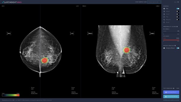 Lunit INSIGHT MMG, AI solution for breast cancer detection from mammograms