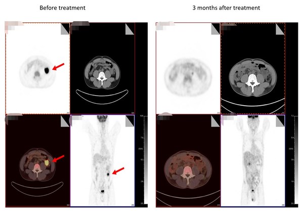 Comparison of pre- and post-treatment imaging