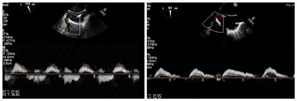 图4.术前（左）与术后（右）经食道脉冲多普勒肝静脉血流图
