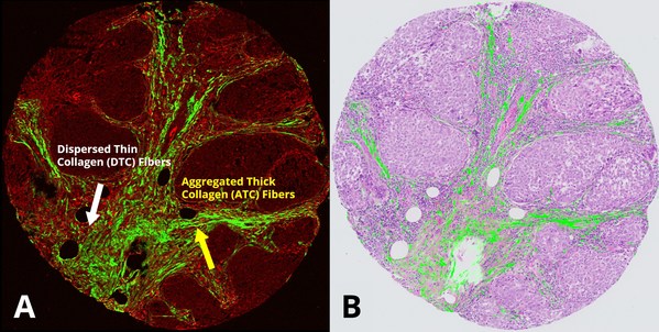 Figure 1: Picture A shows a patient’s TNBC biopsy scanned by HistoIndex’s stain-free AI digital pathology platform. The collagen fibers as well as changes in collagen structures are highlighted in green when detected by SHG and shows a comparison of the tissue area occupied by the ATC and DTC fibers based on intensity, texture, and morphology. Picture B shows an overlay of the collagen structure acquired by SHG onto an image stained with Haemotoxylin and Eosin (H&E), which is commonly used in conventional pathology. With SHG imaging, the ATC and DTC fibers were revealed to be of prognostic value based on the patient cohort and clinical outcomes. And when analyzed separately, the key collagen-associated parameters provided a novel understanding of collagen remodeling during cancer progression [3]. Image Credits: Institute of Molecular and Cell Biology.