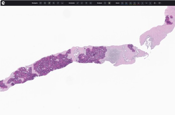 Paige Prostate indicating areas suspicious for cancer on FullFocus