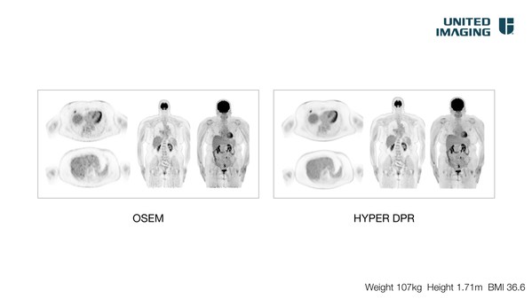 The newly-minted uAI® HYPER DPR (Deep Progressive Reconstruction) is the only AI PET reconstruction technology in the market trained on high-count, total-body PET data to support small lesion detectability and improve quantitative accuracy.