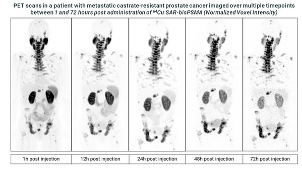 PET scans in a patient with metastatic castrate-resistant prostate cancer imaged over multiple timepoints between 1 and 72 hours post administration of Cu-64 SAR-bisPSMA (Normalized Voxel Intensity)