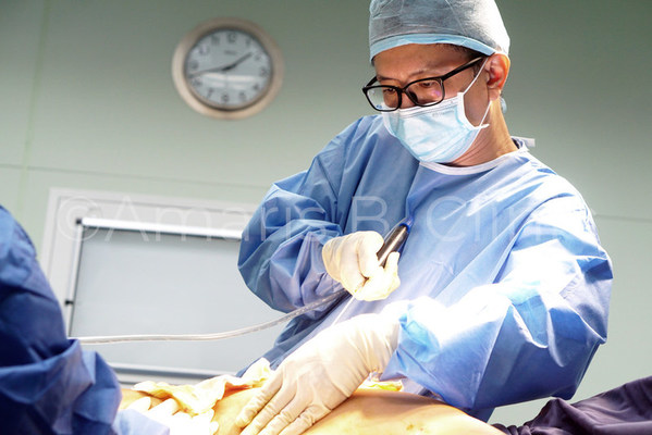Dr. Ivan Puah is seen above performing a liposuction surgery on a male patient in Singapore, applying the MDC-Sculpt®️ Lipo technique.
