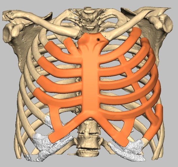 Massive ribcage reconstruction planned with AnatomicsRx C3D software.