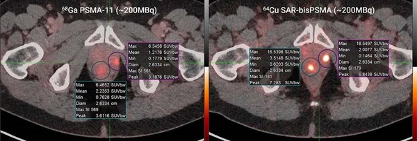 Ga-68 PSMA-11 (~200MBq, left) vs. Cu-64 SAR-bisPSMA (~200MBq, right) in the same patient; time between serial imaging was 8 days. Standardised Uptake Value (SUVmax)* of the lesions were 6.5 and 6.3 for Ga-68 PSMA-11 and 16.5 and 18.5 for Cu-64 SAR-bisPSMA