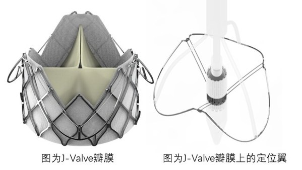 J-Valve瓣膜上的定位翼完全张开，可以找到主动脉窦并能自我调整对准瓣膜植入点；杰成将这一过程命名为“自主导航定位系统”