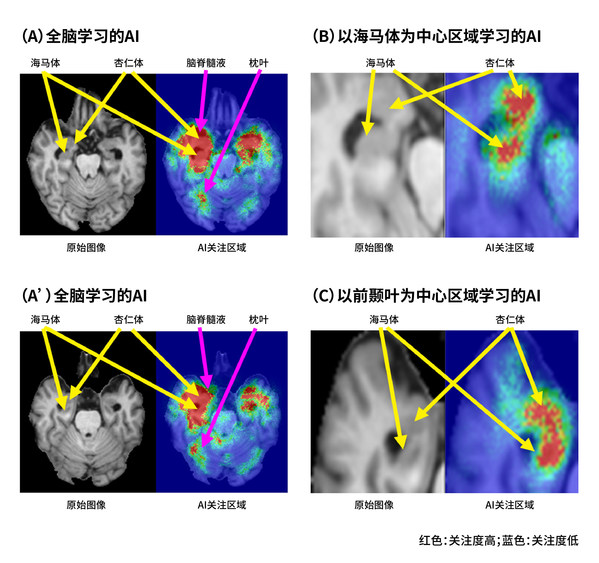 富士膠片AI技術可預測認知癥是否會進展為阿爾茨海默病
