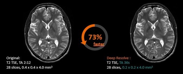 Deep Resolve可将颅脑扫描时间降低70%，并将成像分辨率提高2倍，并可保持相同的图像质量
