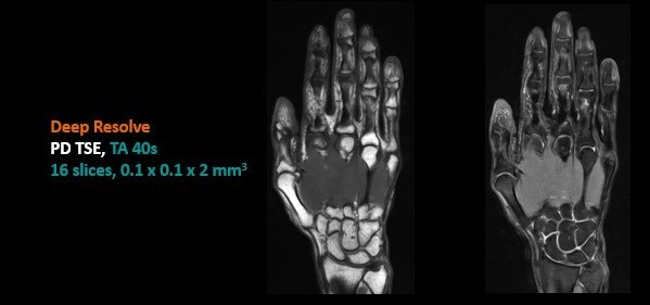 Deep Resolve实现手部100um超高分辨率成像，将MR影像提高到空前水平