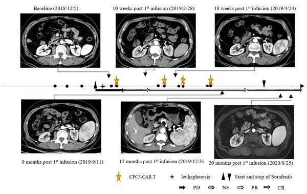 Case Report of Long Term Complete Response in Hepatocellular Carcinoma to CARsgen's GPC3 CAR T Cells (CT011) Published in Frontiers in Immunology