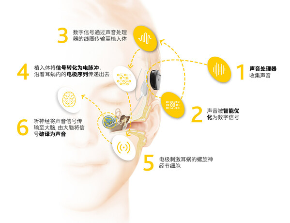 人工耳蜗植入体和声音处理器协同工作原理
