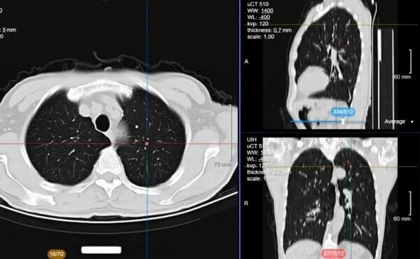 医学影像学（放射）图像标注——肺部结节CT数据标注