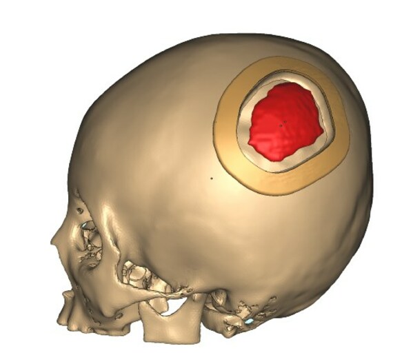 颅骨PEEK植入导板方案图片
