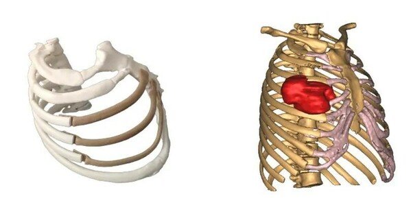 采用远铸智能FUNMAT PRO 610进行3D打印的PEEK胸肋骨植入物