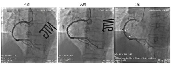 左：術前靶病變處造影；中：IBS®支架植入後造影；右：術後1年造影，結果顯示支架內通暢，未見明顯狹窄