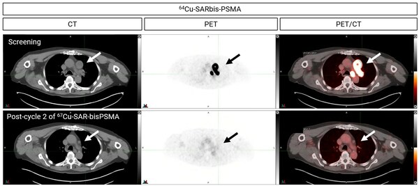 Figure 1. PET/CT images showing uptake of Cu-64 SAR-bisPSMA at screening in a patient with mCRPC (top). The patient received 2 cycles of Cu-67 SAR-bisPSMA at 8 GBq. Images post-treatment show no Cu-64 SAR-bisPSMA uptake (bottom).