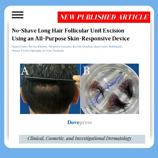 Novel Device Facilitates Successful No-Shave FUE Transplants for Long Hair with Ease