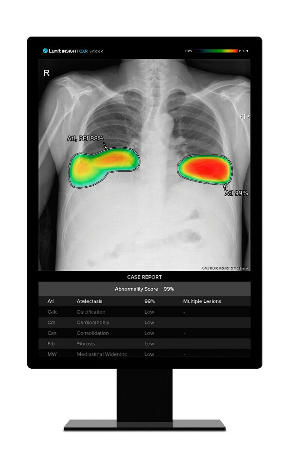 Lunit's AI-powered chest X-ray analysis solution, "Lunit INSIGHT CXR"