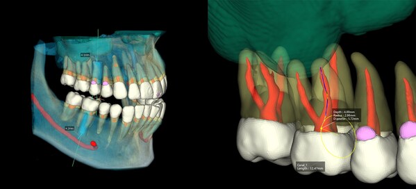 Example of using AI to estimate clinically relevant anatomical clinical structures(left),  AI 3D Segmentation tech(right)