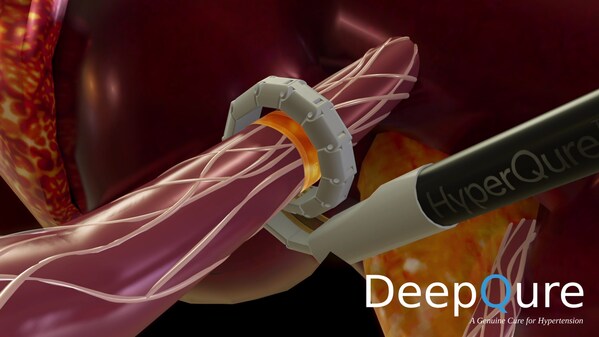 DeepQure initiates Early Feasibility Study for the HyperQure, the world's first extravascular RDN medical device for the treatment of resistant hypertension.
