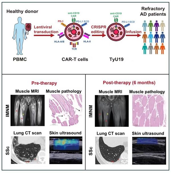 圖1 邦耀生物UCAR-T產(chǎn)品“TyU19”的設計和體內(nèi)作用