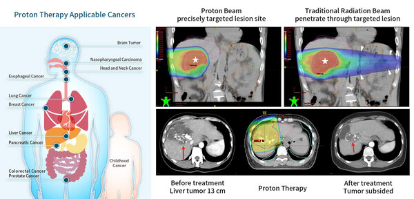 Proton therapy treats a variety of cancers, including brain tumors, nasopharyngeal carcinoma, lung, breast, and liver cancers. It targets tumors with precision, minimizing damage to surrounding healthy tissue compared to conventional X-ray radiation therapy. This method reduces radiation-induced side effects and is particularly effective in treating extensive liver cancers, enhancing patients' survival prospects. (Courtesy of Chang Gung Memorial Hospital, Linkou)