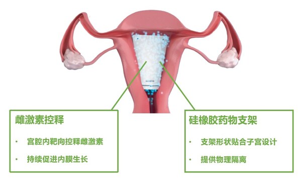 佩朵?置于宮腔內(nèi)，提供完整物理阻隔的同時(shí)，能夠在宮內(nèi)持續(xù)釋放雌激素藥物