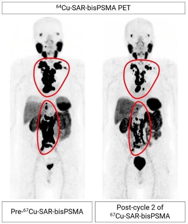 Figure 2. mCRPC patient from cohort 4 showing extensive metastasis of prostate cancer to the lymph nodes (regions highlighted by the red lines). 64Cu-SAR-bisPSMA images show reduction in tumour volume of 60.6% from pre- to post-treatment after two therapy cycles of 12GBq 67Cu-SAR-bisPSMA to date. PSA reduction of 92.3% (from 157.4 to 12.1 ng/mL) to date. Post-cycle 2 scan (64Cu-SAR-bisPSMA) performed approximately 8 weeks after the second dose of 67Cu-SAR-bisPSMA.