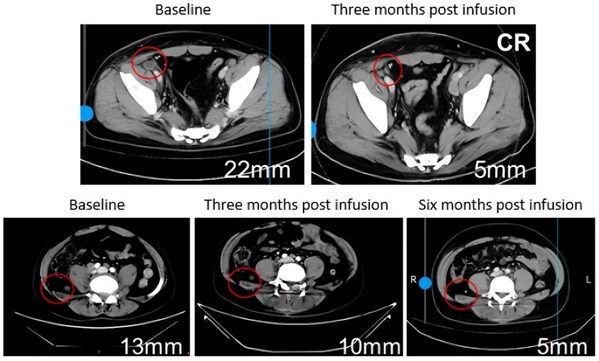 75% of patients experiencing a sustained reduction in tumor burden and diminished metabolic activity, and several lesions achieving complete response (CR) with 100% tumor reduction.