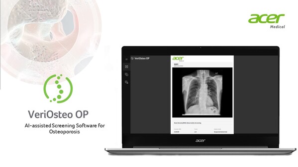 AI-Assisted Bone Mineral Density Abnormality Screening Software - VeriOsteo OP