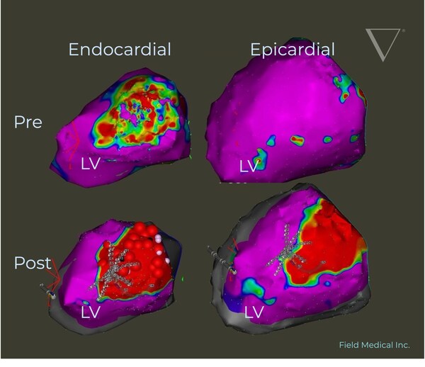 Pre and post voltage map demonstrating Field Medical’s technology creating transmural LV ablation lesions from endocardial treatment alone. This image is from a VCAS Study subject treated with FieldForce for VT Ablation.